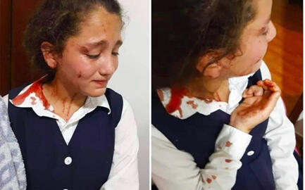 Effects left on a Palestinian girl who was beaten by an illegal colonial settler while leaving school