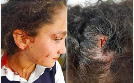 Effects left on a Palestinian girl who was beaten by an illegal colonial settler while leaving school